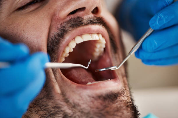 Best Emergency Tooth Extraction in Channel Lake, IL